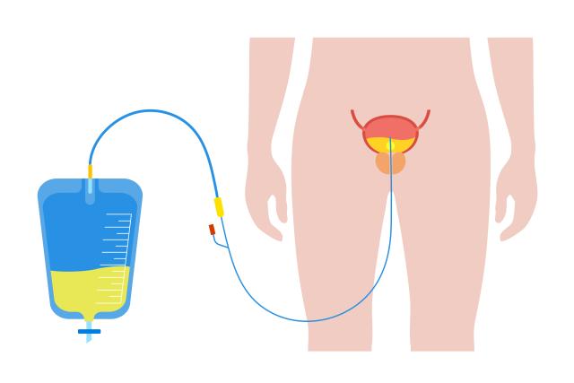 Types of Urinary Catheters: A Comprehensive Guide