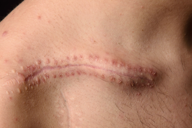 Top Innovations in Scar Treatment Solutions: A Comprehensive Guide