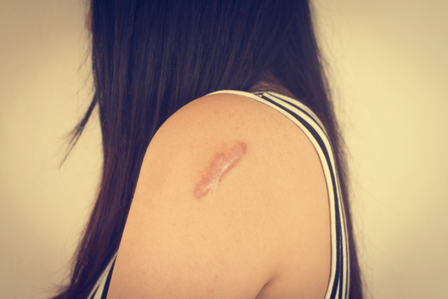 Effective Scar Treatment Options for Different Types of Scars